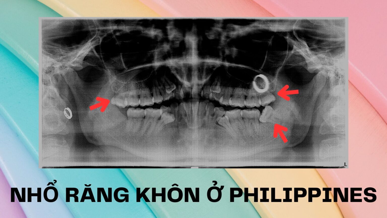 nhổ răng khôn ở philippines