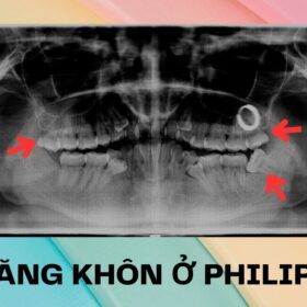 nhổ răng khôn ở philippines